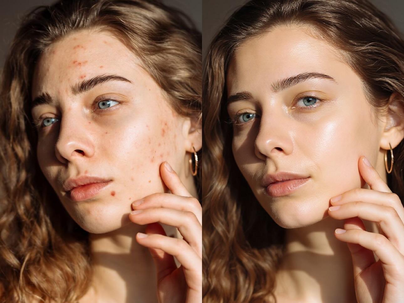 ✅ Remove imperfeições